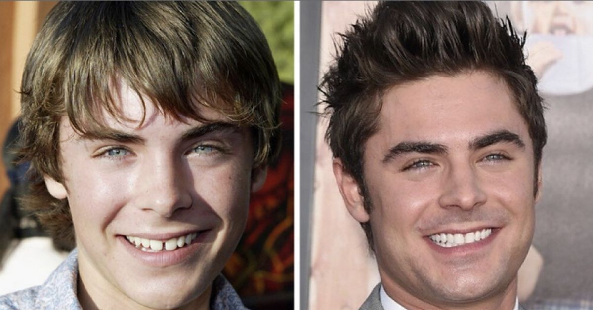 Zac Efron e outras celebridades que costumavam ter dentes muito diferentes