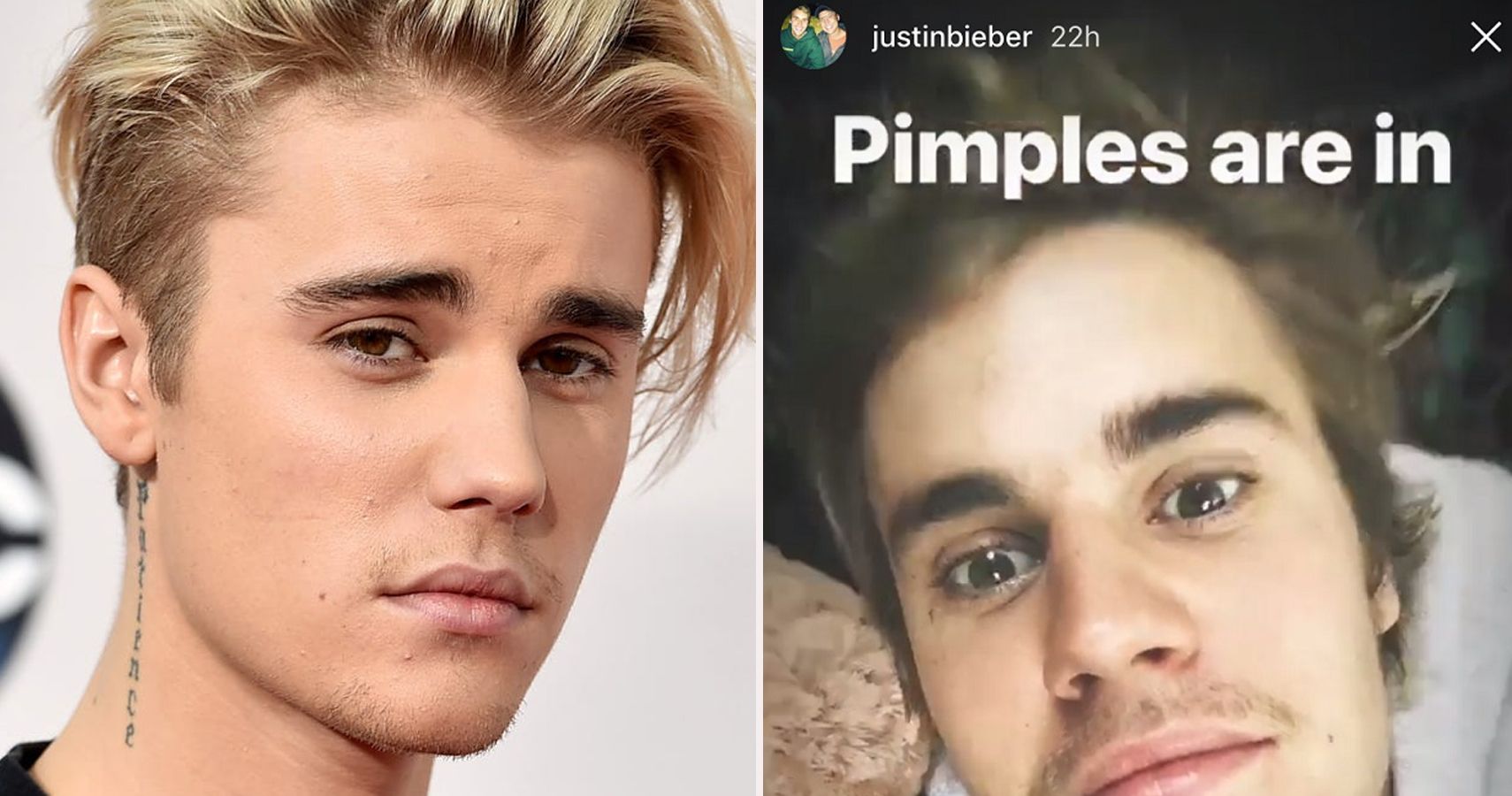 De espinhas à perfeição … Como Justin Bieber colocou sua pele sob controle