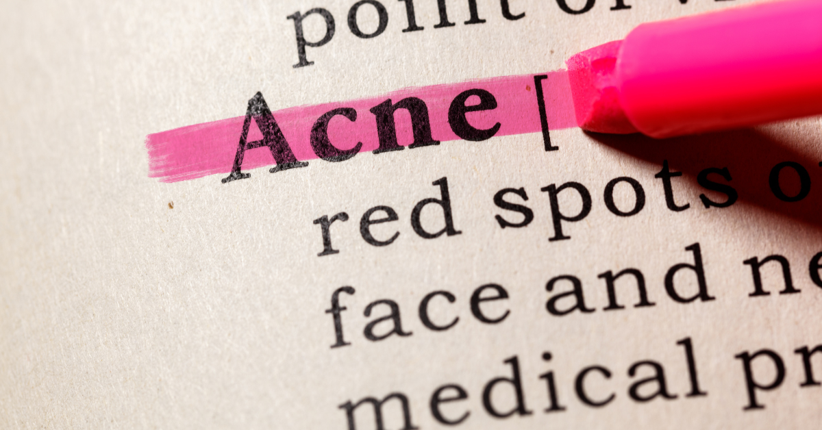 A verdade sobre a acne cística, o que funciona e o que não funciona
